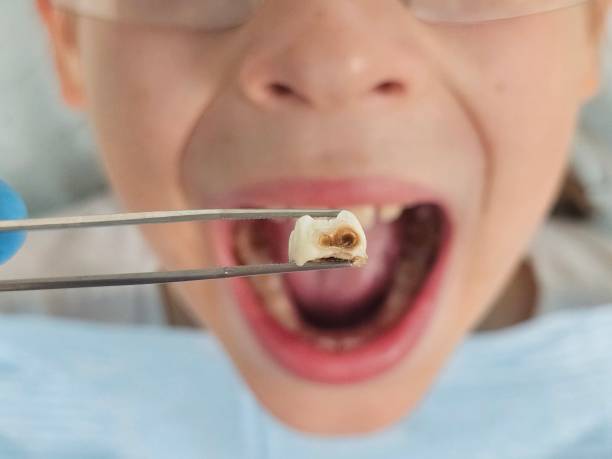 Best Emergency Tooth Extraction in Muniz, TX